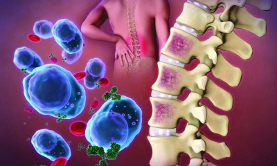 دواء "Lynozyfic".. أول علاج ثنائي النوعية للورم النخاعي المتعدد المقاوم للعلاج
