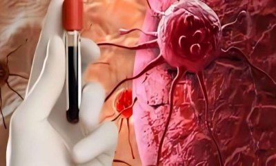 تغييرات في تعليمات علاج أورام الدم تجعله أسهل وأقل إرهاقا للمرضى