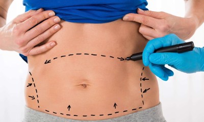 شد البطن قد يحفز فقدان الوزن لمدة 5 سنوات بعد الجراحة