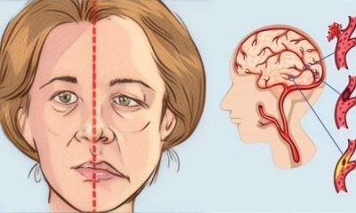5 مضاعفات للحمل قد تنبئ بالسكتة الدماغية بعد عقود