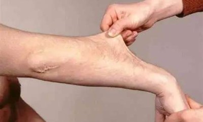 أعراض متلازمة إهلرز دانلوس