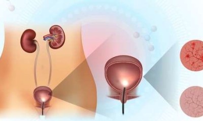 الوقاية من التهابات المسالك البولية