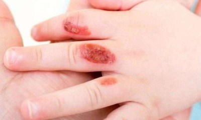 التعامل مع حروق الأطفال في المنزل