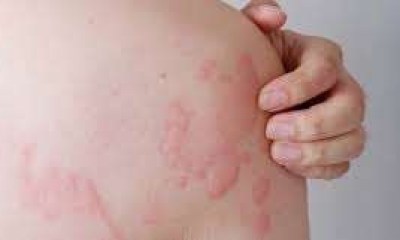 متى تصبح خلايا النحل الجلدية خطيرة؟