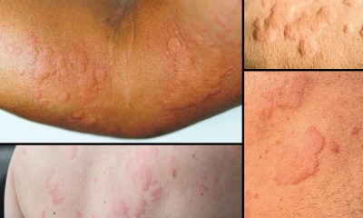 متى تصبح خلايا النحل الجلدية خطيرة؟