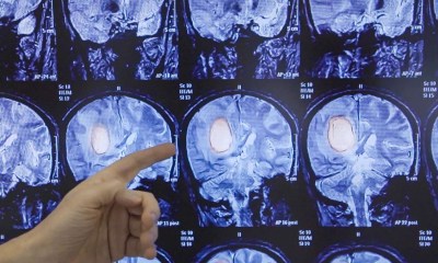 موافقة خاصة على دواء جديد لعلاج ورم نادر في الدماغ