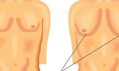 دواء Risperdal يسبب نمو الثدي عند الرجال