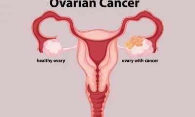كيف تتعرفين على الأعراض المبكرة لأورام المبيض؟