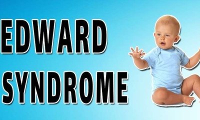 3 خيارات علاجية لدعم أطفال متلازمة إدواردز