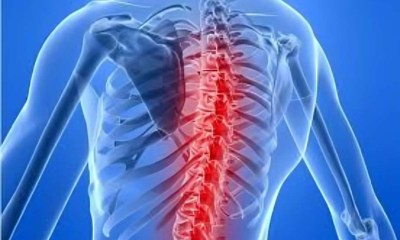  مرض ضمور العضلات الشوكي