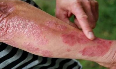 6 نصائح ذكية لمرضى الصدفية في فصل الصيف