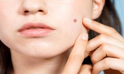 لماذا تظهر الشامات الجلدية بكثرة عند مرضى السكري؟