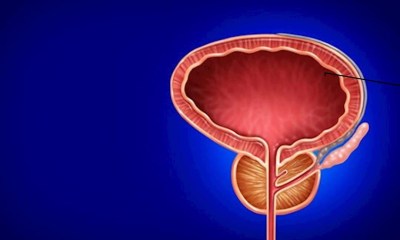 ما المشروبات التي يجب تجنبها مع تضخم البروستاتا؟