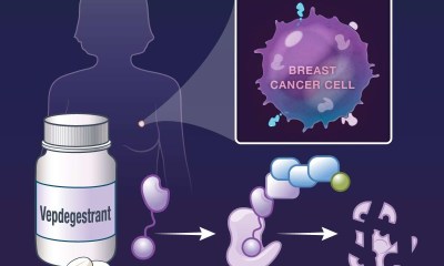 دواء جديد يظهر نتائج ملحوظة في علاج أورام الثدي المتقدمة
