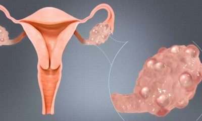 كل الوقاية من أورام المبيض كانت ممكنة؟
