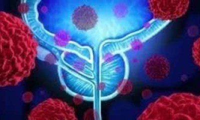 أورام البروستاتا بعد السبعين