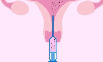 6 حالات طبية تستدعي اللجوء إلى التلقيح الصناعي