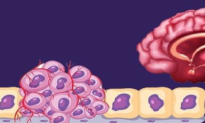 ارتفاع معدلات الشفاء من أورام الجهاز العصبي لدى الأطفال في أوروبا
