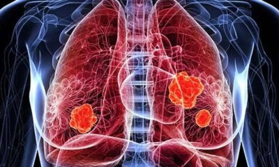 أول دواء يعالج السبب الجذري لأورام الجهاز التنفسي الحليمية المتكررة