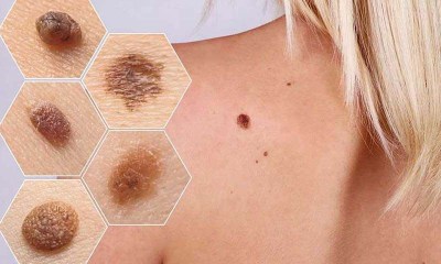 لاصقة ذكية جديدة تكشف أورام الجلد في المنزل