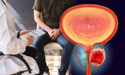 %50 من مرضى أورام البروستاتا يفضلون المراقبة النشطة عن العلاج التقليدي