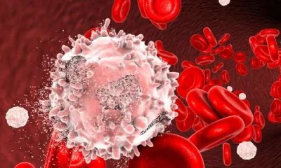 اختبار الخلايا الجذعية يتفوق في التنبؤ بعودة اللوكيميا الحادة