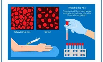 حصول دواء Rusfertide على تصنيف 