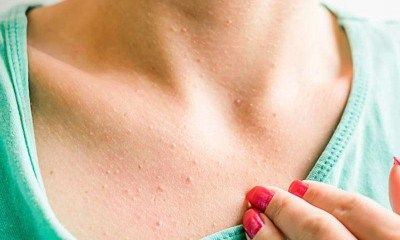 7 حالات صحية وراء الطفح الجلدي على الثديين