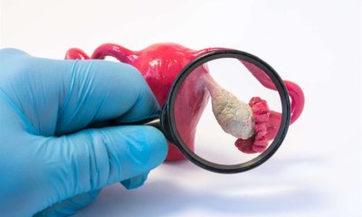 علاج متلازمة تكيس المبايض