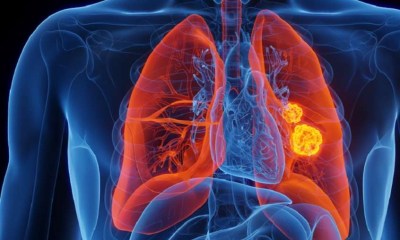 فحص أورام الرئة بعد الـ75 ضرورة ممكنة