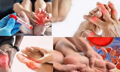 أعراض ارتفاع حمض اليوريك