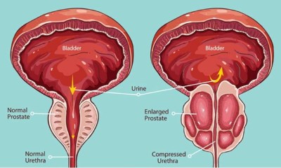  علاج تضخم البروستاتا الحميد