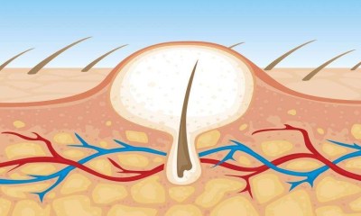 أفضل 3 طرق لعلاج الشعر الناشب في المنزل
