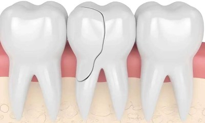 أسباب تشقق الأسنان