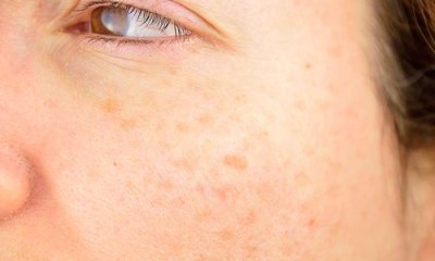 4 خطوات يومية بسيطة لحماية بشرتك من بقع الشمس