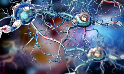 علاج جيني جديد يبطئ تقدم مرض هنتنغتون بنسبة 75%