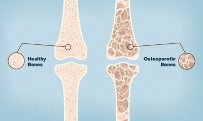 ترخيص &quot;Enoby&quot; كبديل بيولوجي جديد لعلاج هشاشة العظام