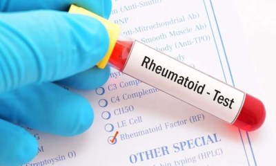مؤشرات حيوية في الدم تنذر بالروماتويد قبل سنوات من ظهوره