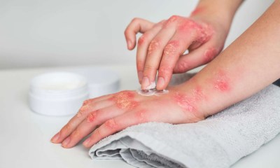 مرضى الصدفية أكثر عرضة للإصابة بالتنكس البقعي المرتبط بالعمر