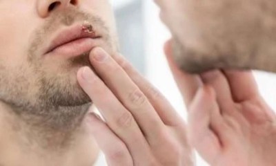 أول علاج فموي يومي يستهدف الأعصاب المصابة بالهربس مباشرة