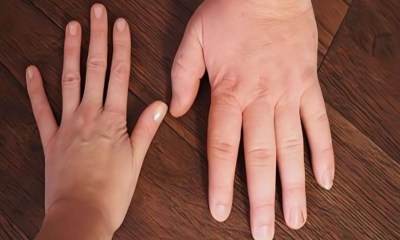 الموافقة على أول علاج فموي يومي لمرض تضخم الأطراف