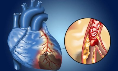 5 عادات يومية تقيك من انسداد الشرايين وأمراض القلب