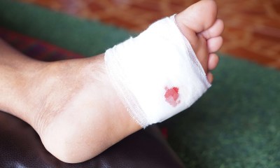 التقرحات الجلدية تشير إلى حالات صحية خفية