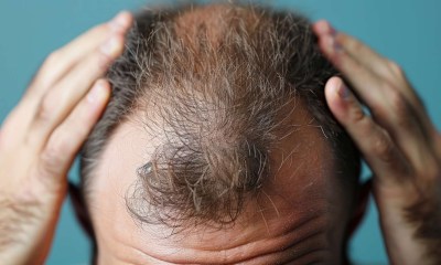 المشروبات السكرية تضر شعر الرجال