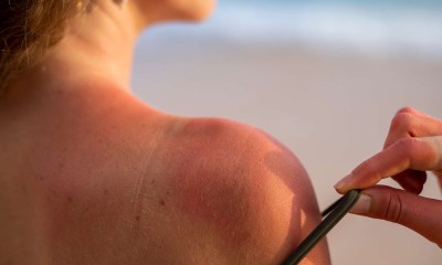 تقشير الجلد بسبب حروق الشمس