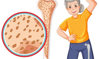 خلايا سرطانية تتكاثر داخل نخاع العظام