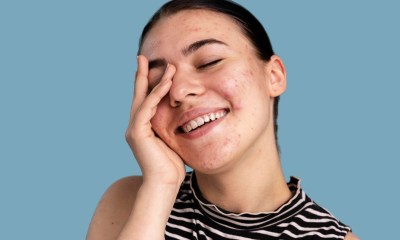 نتوء جلدي أحمر