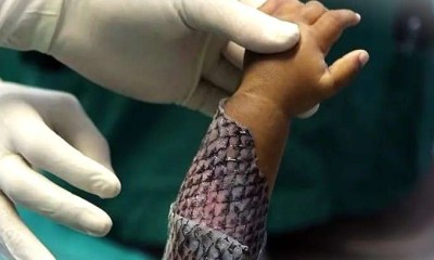 صورة من بي بي سي عن جلد السمك كبديل للترقيع التقليدي