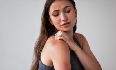 متلازمة الجلد المحروق