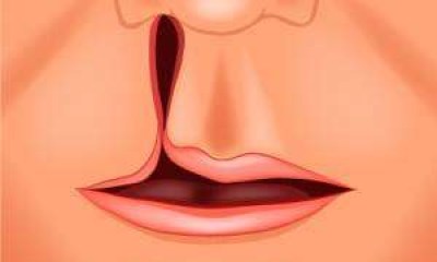 تشوه الشفة الأرنبية